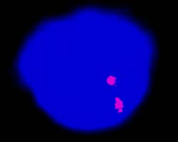 vysis-lsi-atm-11q22.3-hybridization-normal