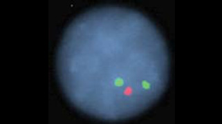 vysis-lsi-atm-spectrumorange-cep11-spectrumgreen-hybridization-abnormal