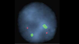 vysis-lsi-atm-spectrumorange-cep11-spectrumgreen-hybridization-normal