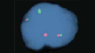 vysis-lsi-birc3-malt1-dual-color-dual-fusion-hybridization-abnormal