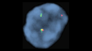 vysis-lsi-ccnd1-break-apart-rearrangement-hybridization-abnormal