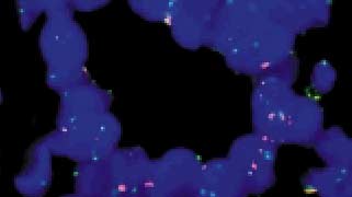 vysis-lsi-cyclin-d1-11q13-cep-11-hybridization-normal