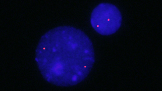 vysis-lsi-mdm2-hybridization-normal.