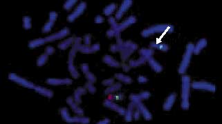 vysis-miller-dieker-region-isolated-lissencephaly-probe-lsi-lis1-lsi-rara-hybridization-normal