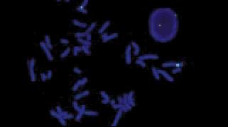 vysis-lsi-whs-hybridization-abnormal